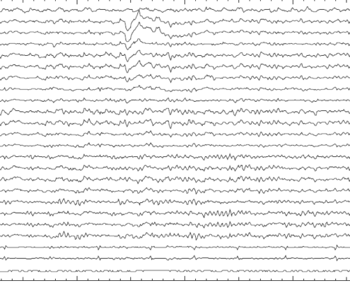 eletroencefalograma exemplo de traçado com interferência de fator externo