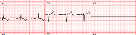 resultado de electrocardiograma con canal apagado