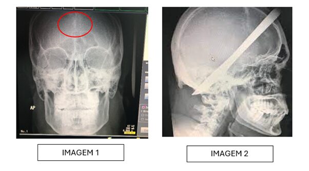 radiografia de crânio AP