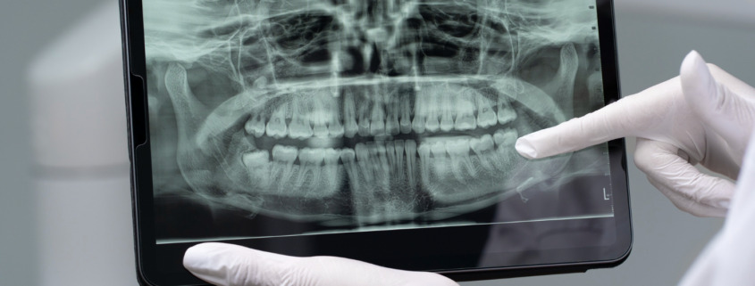 radiografia de boca em tablet com dentista apontando dente específico dos fundos