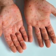 palmas da mão com erupções de mpox
