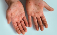 palmas da mão com erupções de mpox
