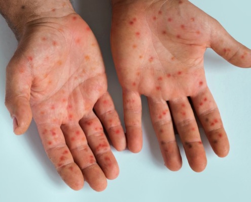 palmas da mão com erupções de mpox