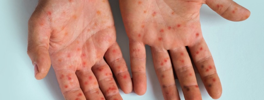 palmas da mão com erupções de mpox
