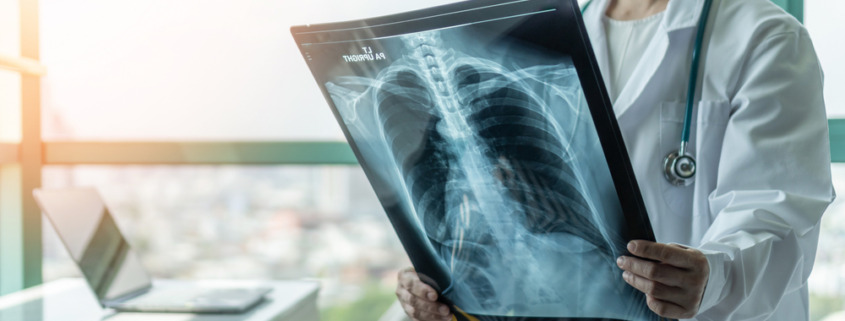 médica em pé analisando radiografia do pulmão